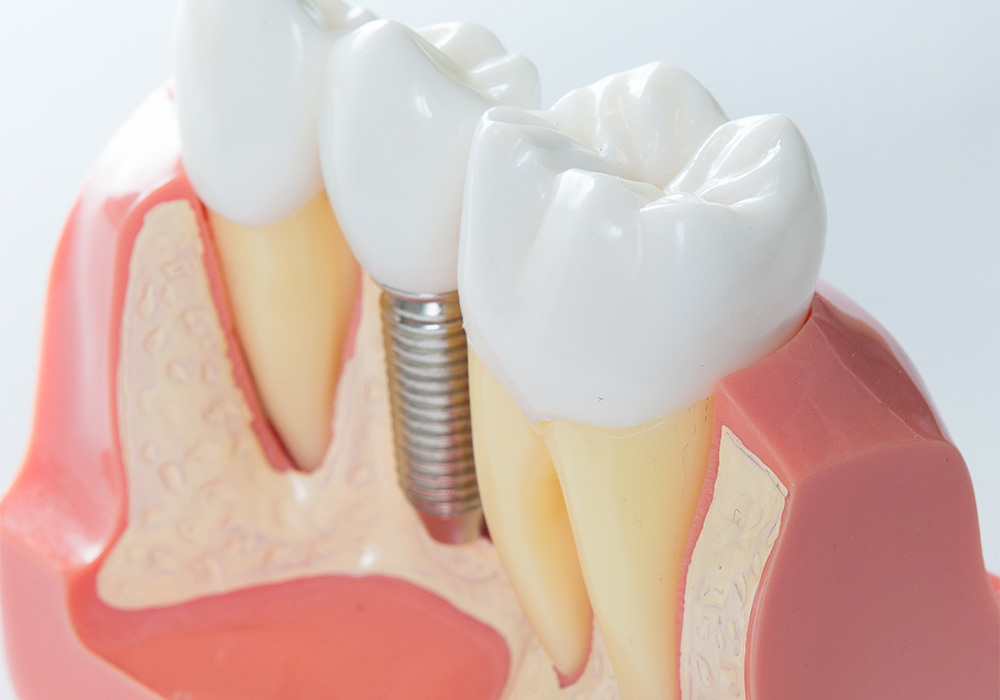 インプラント
